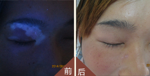 面部白癜风治疗、眼睛白癜风怎么治疗