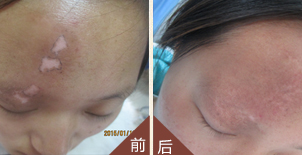白癜风的治疗、怎么治疗白癜风