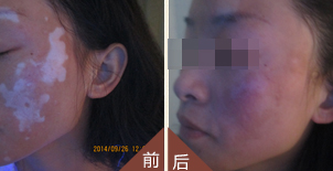28岁女性面部泛发白癜风、3个月康复纪实
