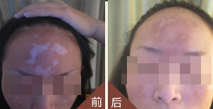 远离白斑，重返自信