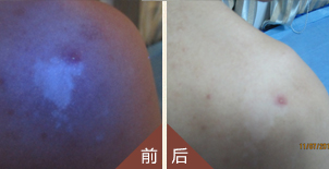 腿部白癜风治疗、胳膊白癜风治疗