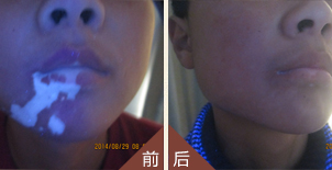 儿童白癜风好治吗、儿童白癜风怎么治