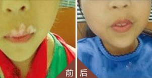 亳州10岁女孩儿嘴巴旁、白斑康复纪实