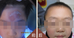 北大祛白、还6岁幼童一张灿烂笑脸